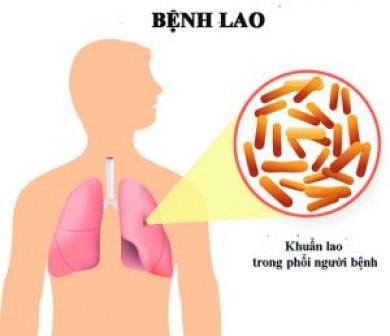 Cách phòng ngừa, hỗ trợ điều trị bệnh lao phổi