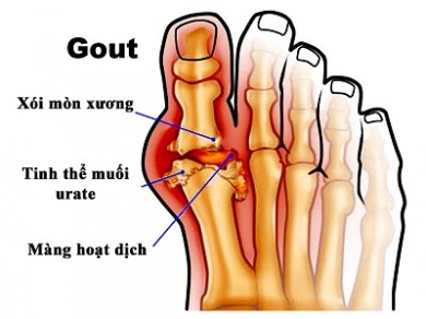 Chuyên đề: Bệnh gout và dinh dưỡng với bệnh gout - File PDF