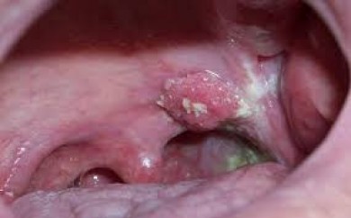 Dấu hiệu nhận biết sớm ung thư vòm họng